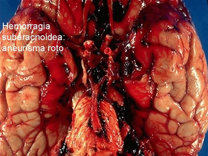 Hemorragia subaracnoidea: aneurisma roto. 