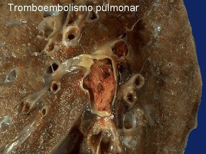 Tromboembolismo pulmonar 