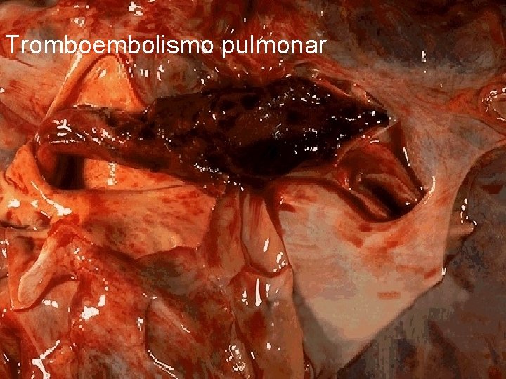 Tromboembolismo pulmonar 