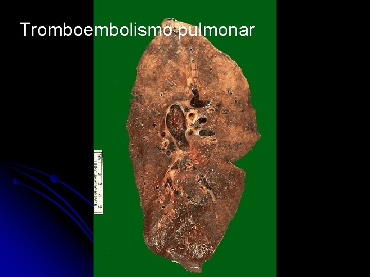 Tromboembolismo pulmonar 