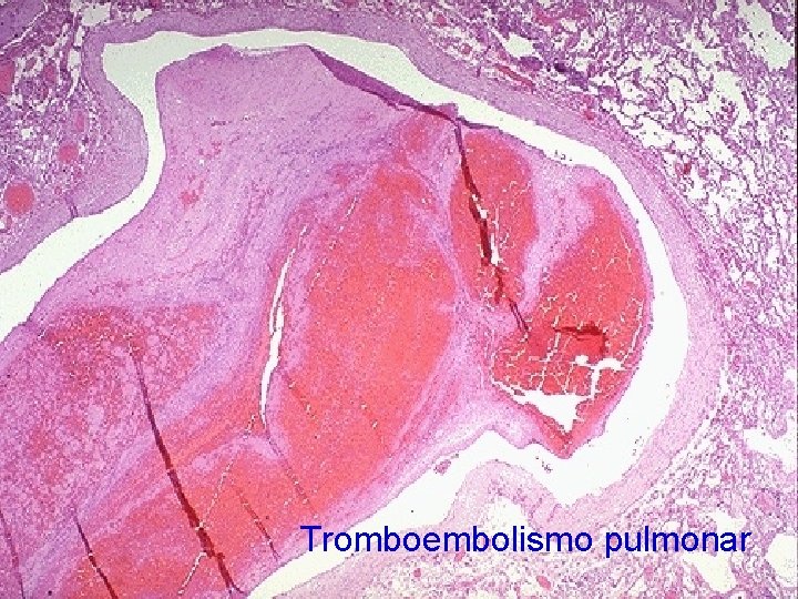 Tromboembolismo pulmonar 