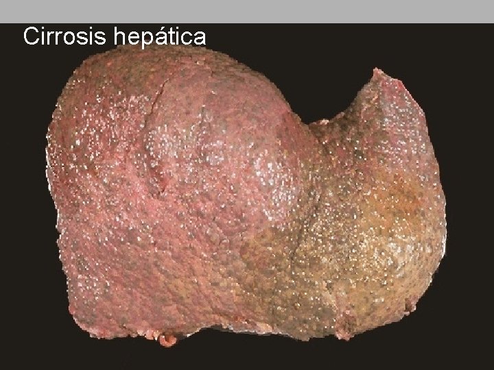 Cirrosis hepática 