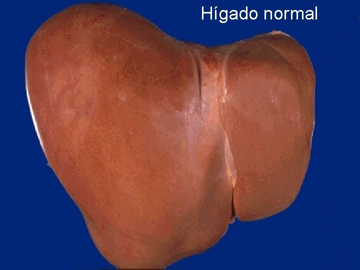 Hígado normal 