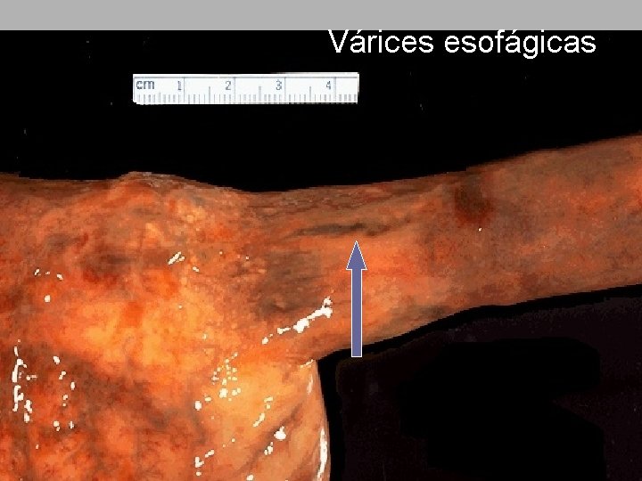 Várices esofágicas 