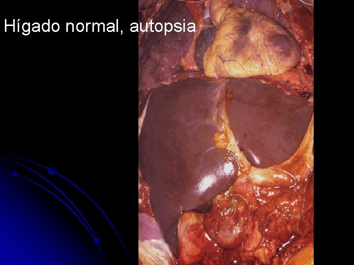 Hígado normal, autopsia 