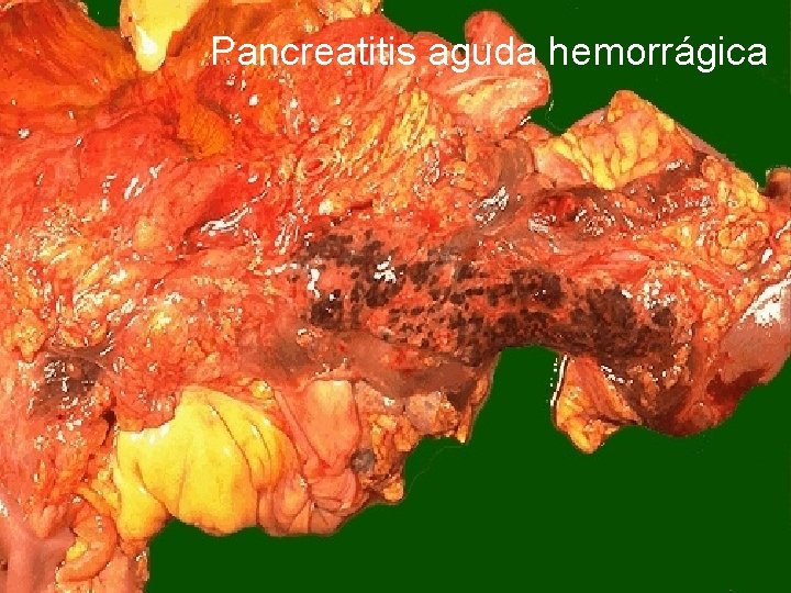 Pancreatitis aguda hemorrágica 