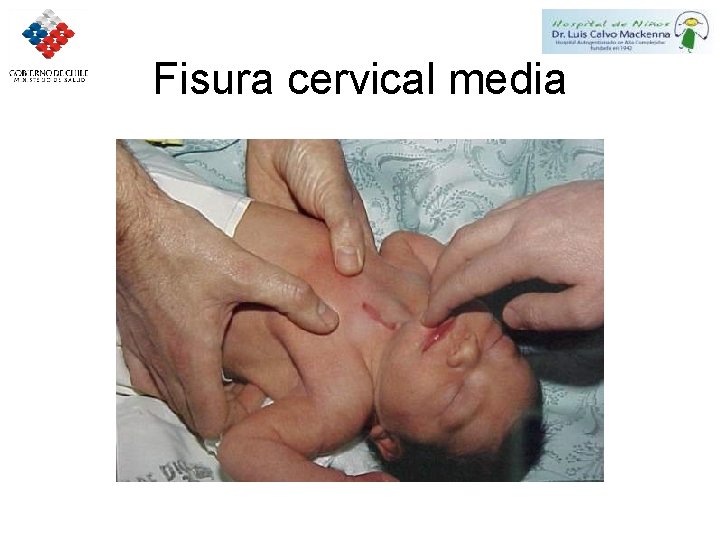 Fisura cervical media 