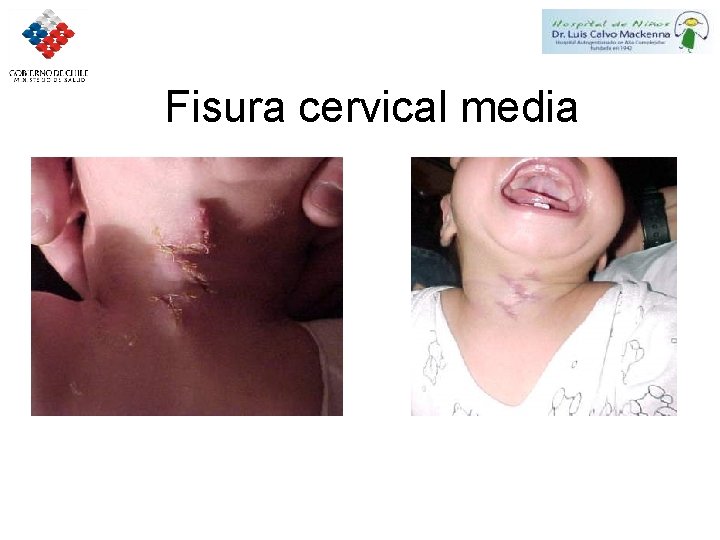 Fisura cervical media 