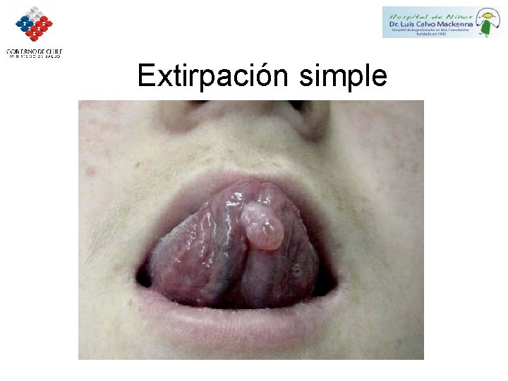 Extirpación simple 