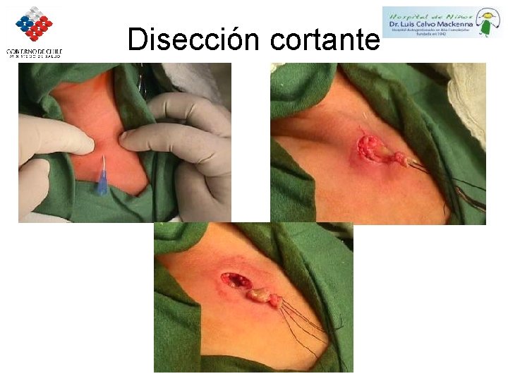 Disección cortante 