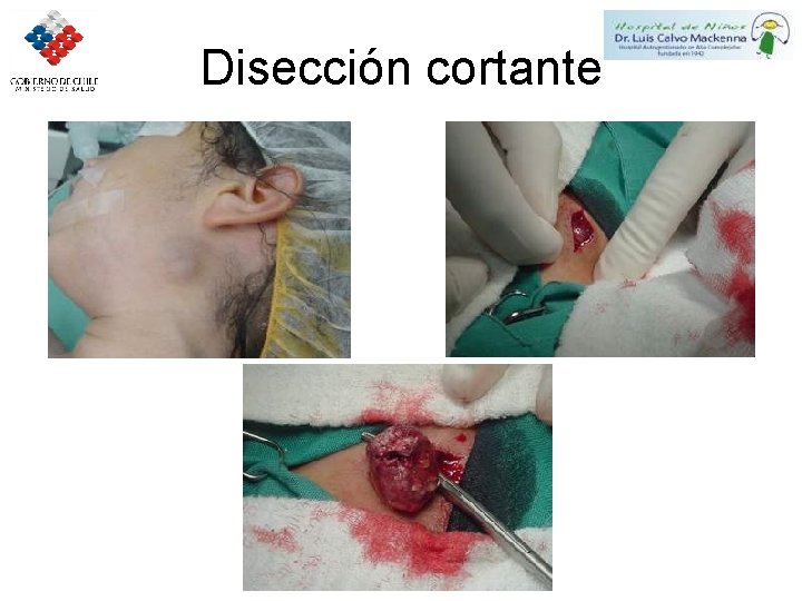 Disección cortante 