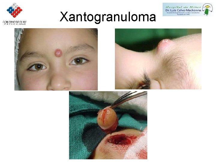 Xantogranuloma 