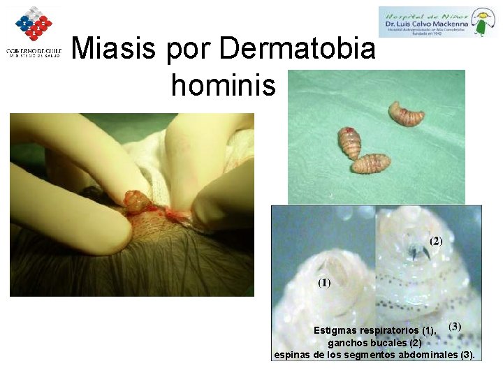 Miasis por Dermatobia hominis Estigmas respiratorios (1), ganchos bucales (2) espinas de los segmentos