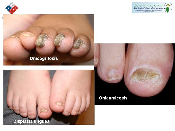 Onicogrifosis Onicomicosis Displasia ungueal 