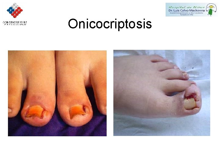 Onicocriptosis 