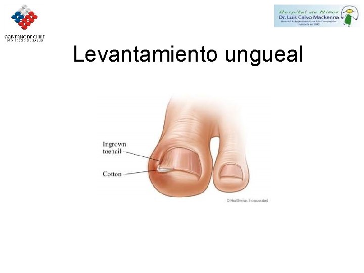 Levantamiento ungueal 