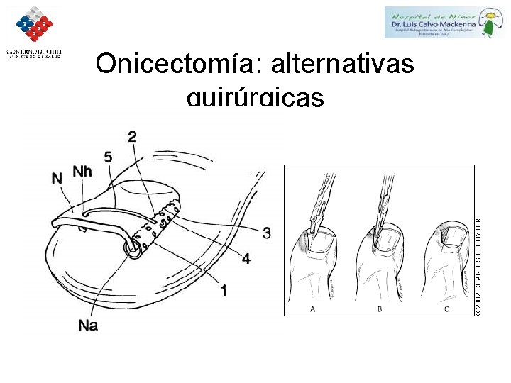 Onicectomía: alternativas quirúrgicas 