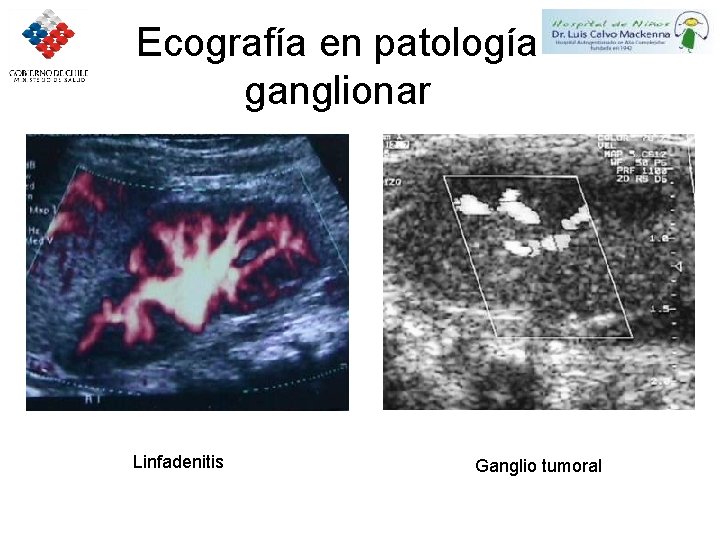 Ecografía en patología ganglionar Linfadenitis Ganglio tumoral 