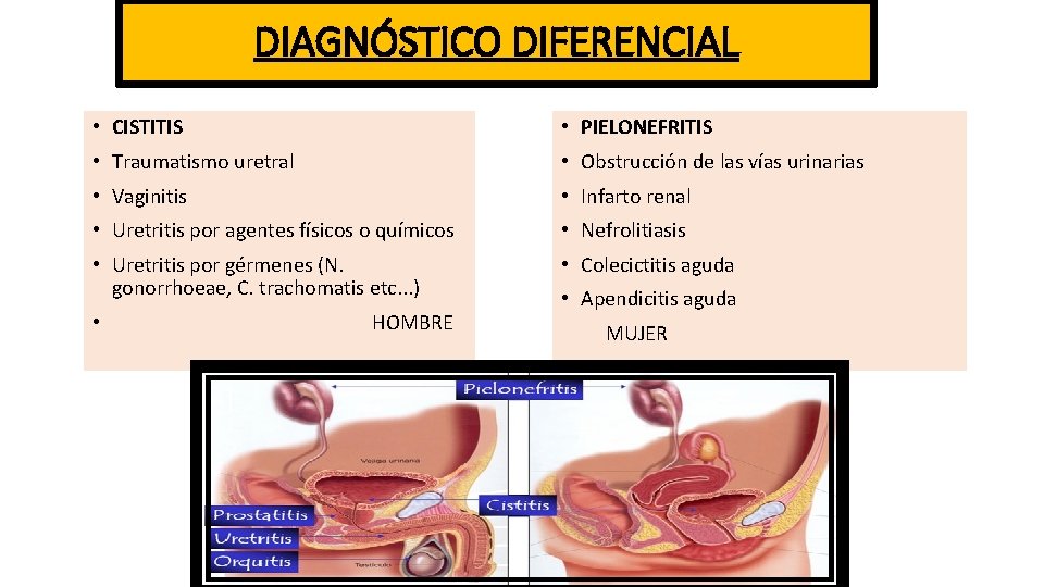 DIAGNÓSTICO DIFERENCIAL • CISTITIS • PIELONEFRITIS • Traumatismo uretral • Obstrucción de las vías