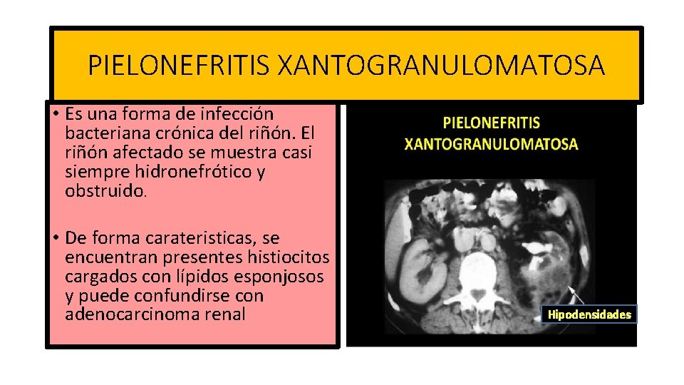 PIELONEFRITIS XANTOGRANULOMATOSA • Es una forma de infección bacteriana crónica del riñón. El riñón