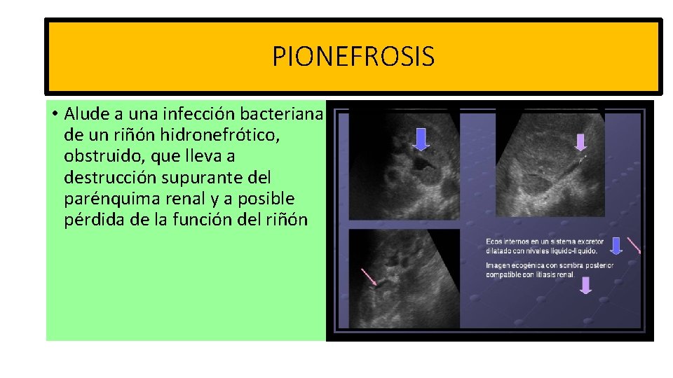 PIONEFROSIS • Alude a una infección bacteriana de un riñón hidronefrótico, obstruido, que lleva