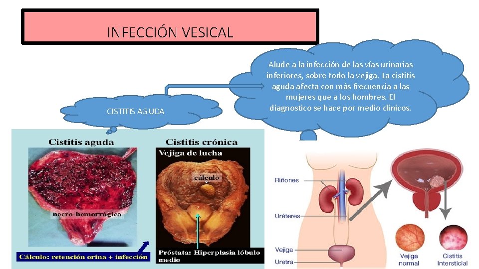 INFECCIÓN VESICAL CISTITIS AGUDA Alude a la infección de las vías urinarias inferiores, sobre