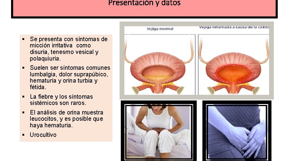 Presentación y datos § Se presenta con síntomas de micción irritativa como disuria, tenesmo