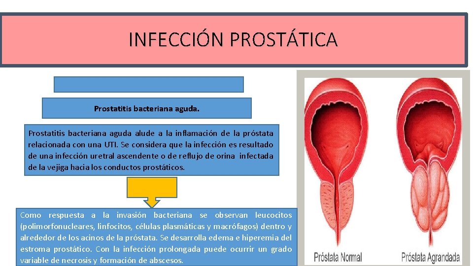 INFECCIÓN PROSTÁTICA Prostatitis bacteriana aguda alude a la inflamación de la próstata relacionada con
