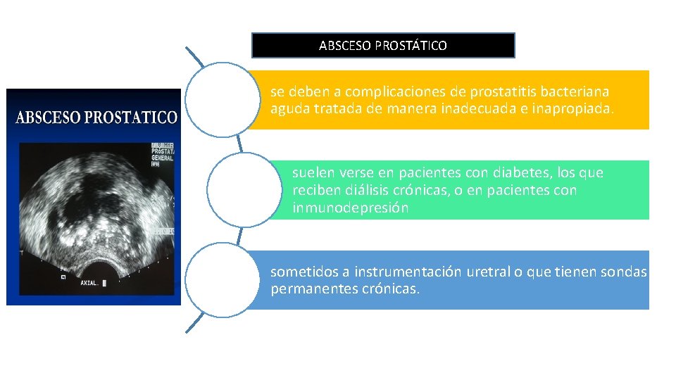 ABSCESO PROSTÁTICO se deben a complicaciones de prostatitis bacteriana aguda tratada de manera inadecuada