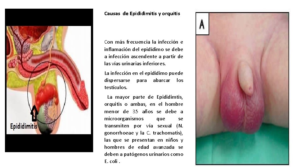 Causas de Epididimitis y orquitis Con más frecuencia la infección e inflamación del epidídimo