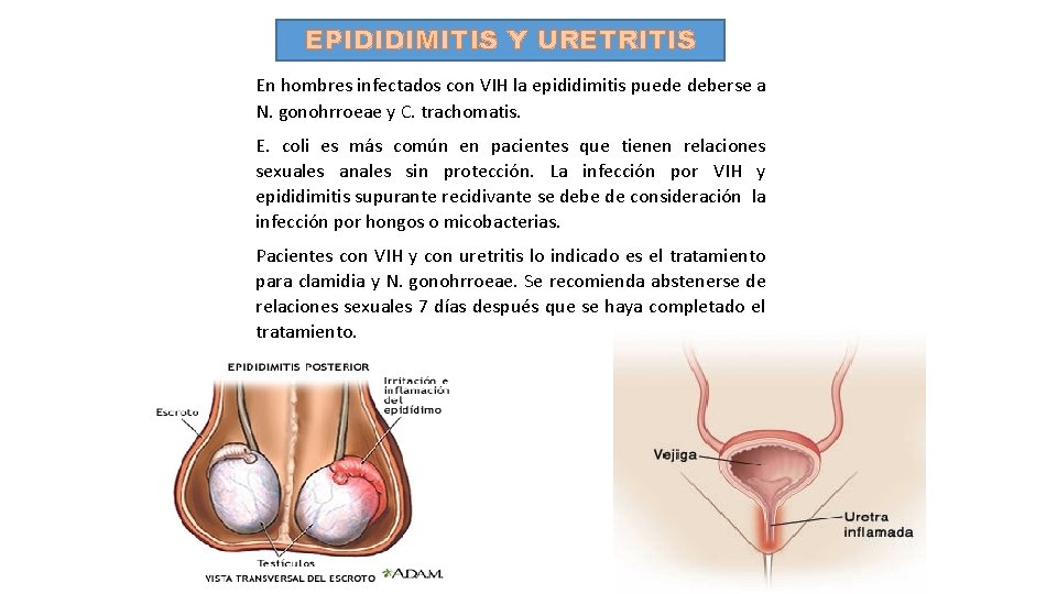 EPIDIDIMITIS Y URETRITIS En hombres infectados con VIH la epididimitis puede deberse a N.