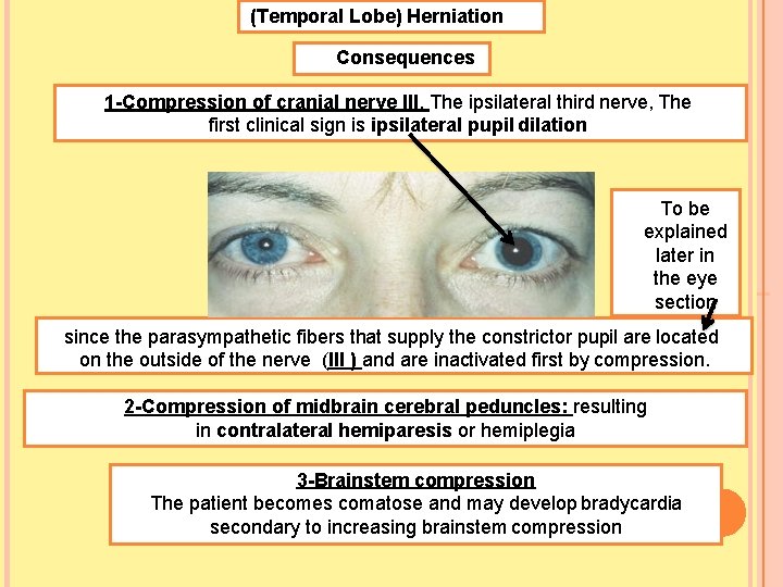 (Temporal Lobe) Herniation Consequences 1 -Compression of cranial nerve III. The ipsilateral third nerve,