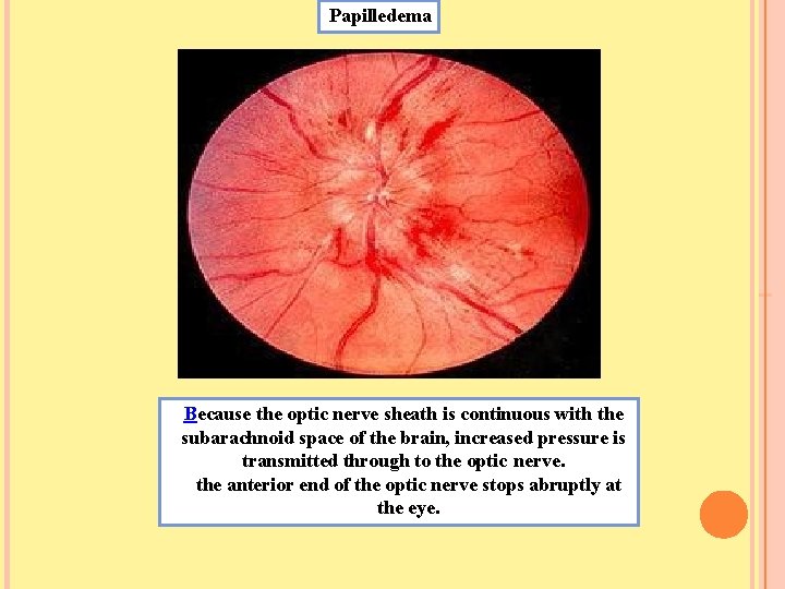 Papilledema Because the optic nerve sheath is continuous with the subarachnoid space of the