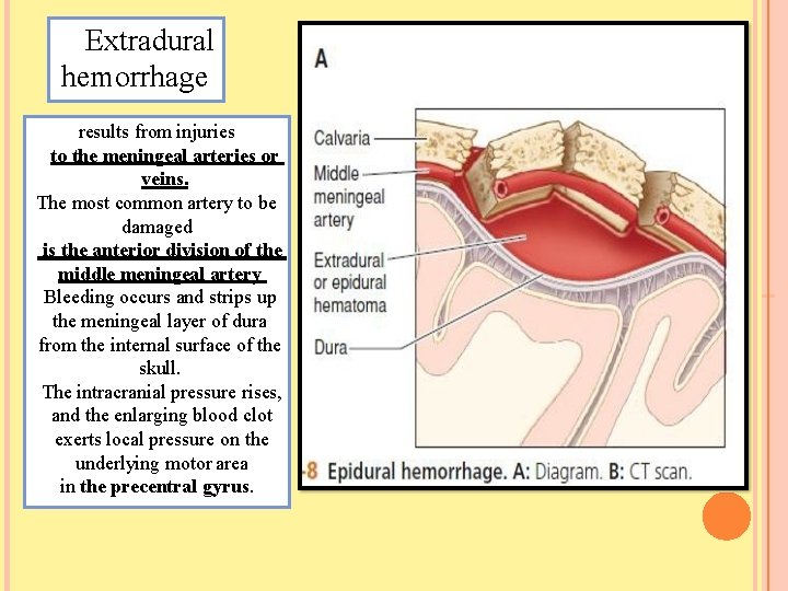 Extradural hemorrhage results from injuries to the meningeal arteries or veins. The most common