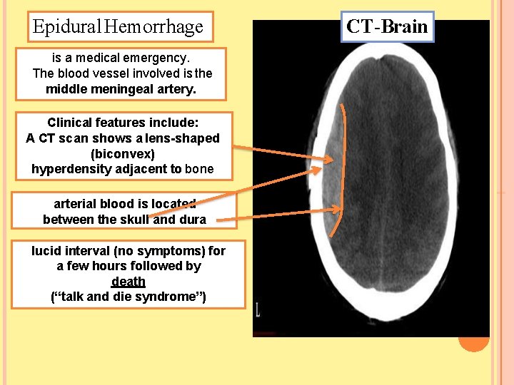 Epidural Hemorrhage is a medical emergency. The blood vessel involved is the middle meningeal