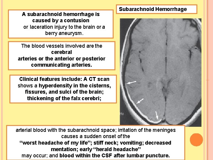 A subarachnoid hemorrhage is caused by a contusion or laceration injury to the brain
