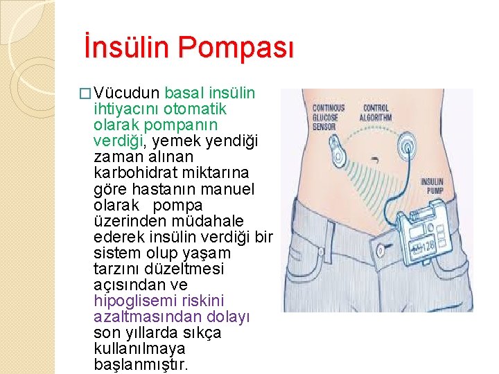 İnsülin Pompası � Vücudun basal insülin ihtiyacını otomatik olarak pompanın verdiği, yemek yendiği zaman