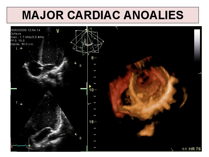 MAJOR CARDIAC ANOALIES 