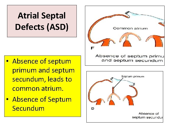 Atrial Septal Defects (ASD) • Absence of septum primum and septum secundum, leads to