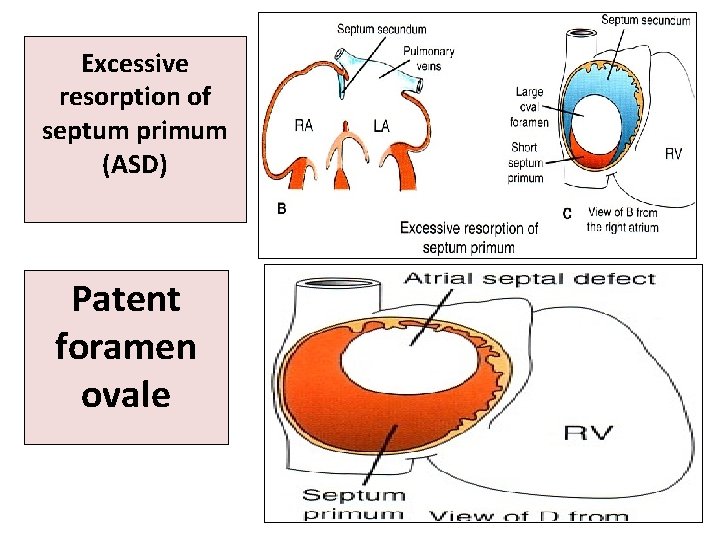 Excessive resorption of septum primum (ASD) Patent foramen ovale 