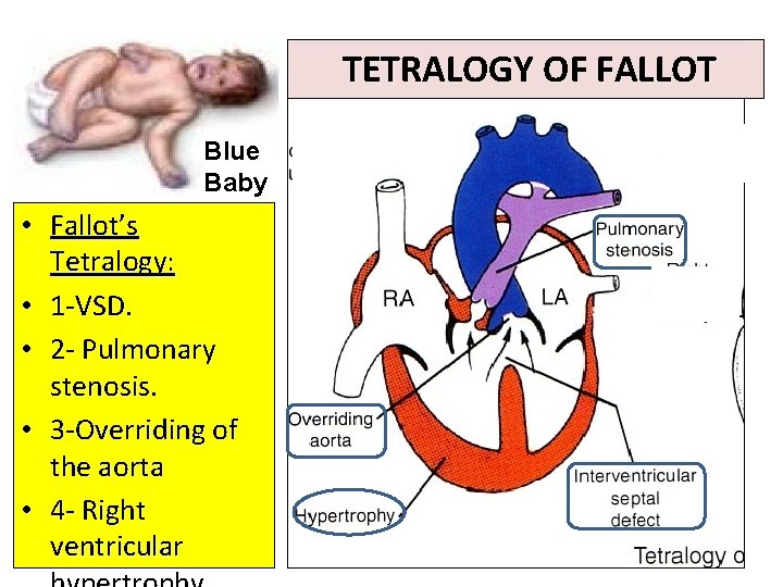 TETRALOGY OF FALLOT Blue Baby • Fallot’s Tetralogy: • 1 -VSD. • 2 -