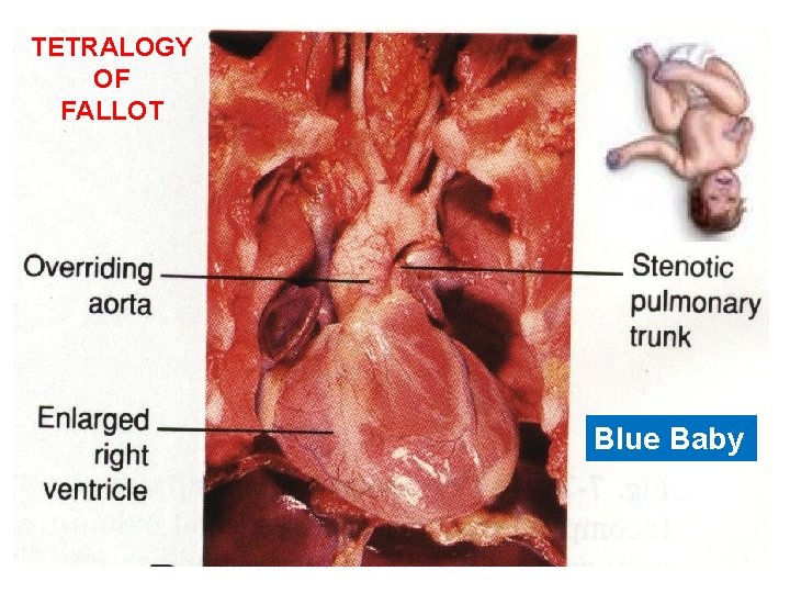 TETRALOGY OF FALLOT Blue Baby 