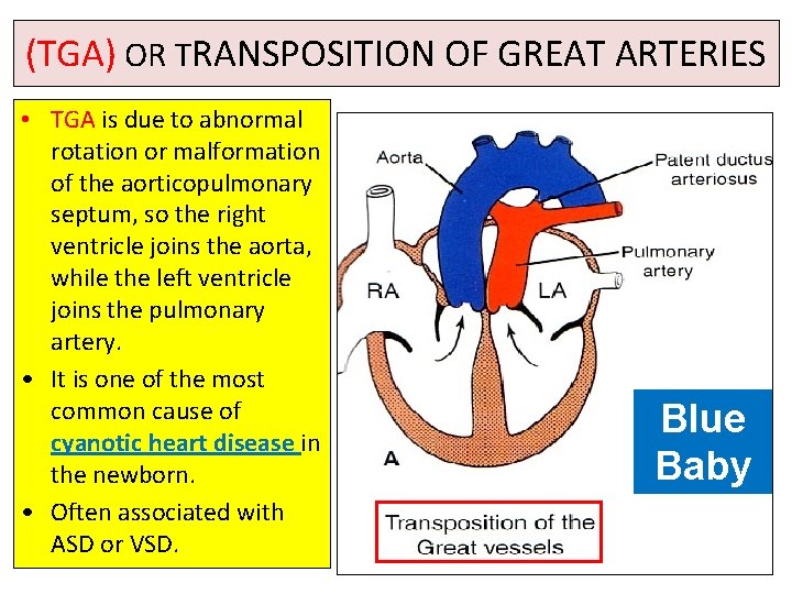 (TGA) OR TRANSPOSITION OF GREAT ARTERIES • TGA is due to abnormal rotation or