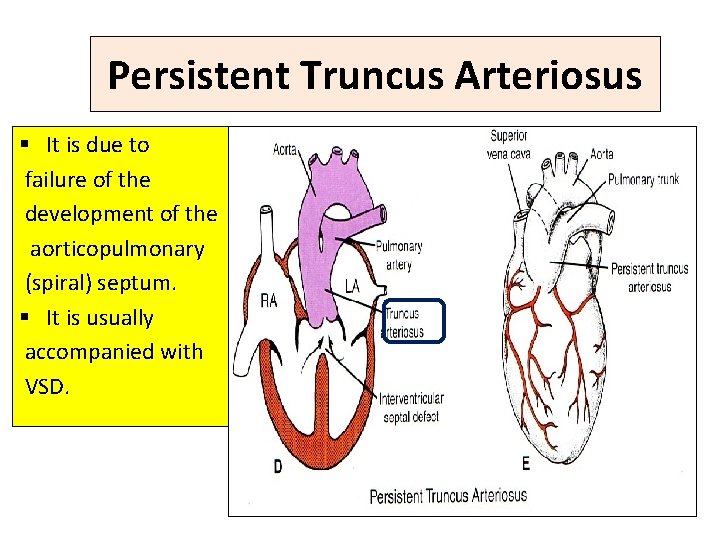 Persistent Truncus Arteriosus § It is due to failure of the development of the