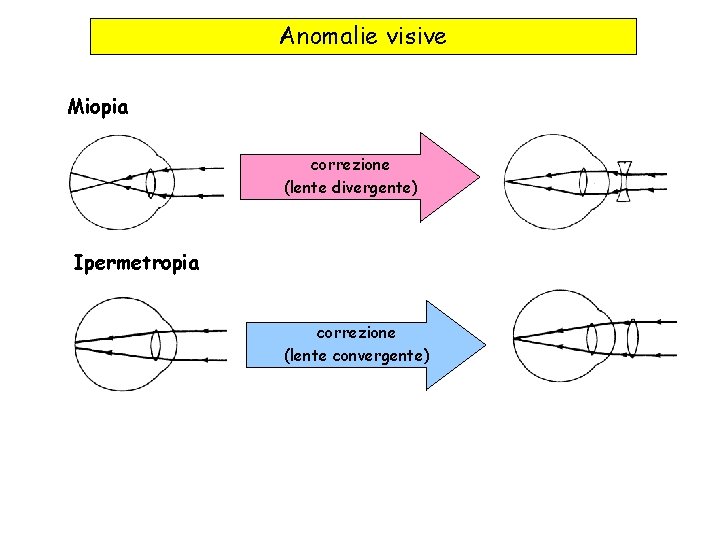 Anomalie visive Miopia correzione (lente divergente) Ipermetropia correzione (lente convergente) 