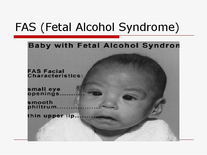 FAS (Fetal Alcohol Syndrome) 