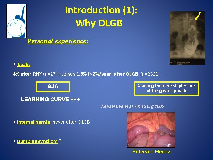 Introduction (1): Why OLGB Personal experience: • Leaks 4% after RNY (n=270) versus 1.