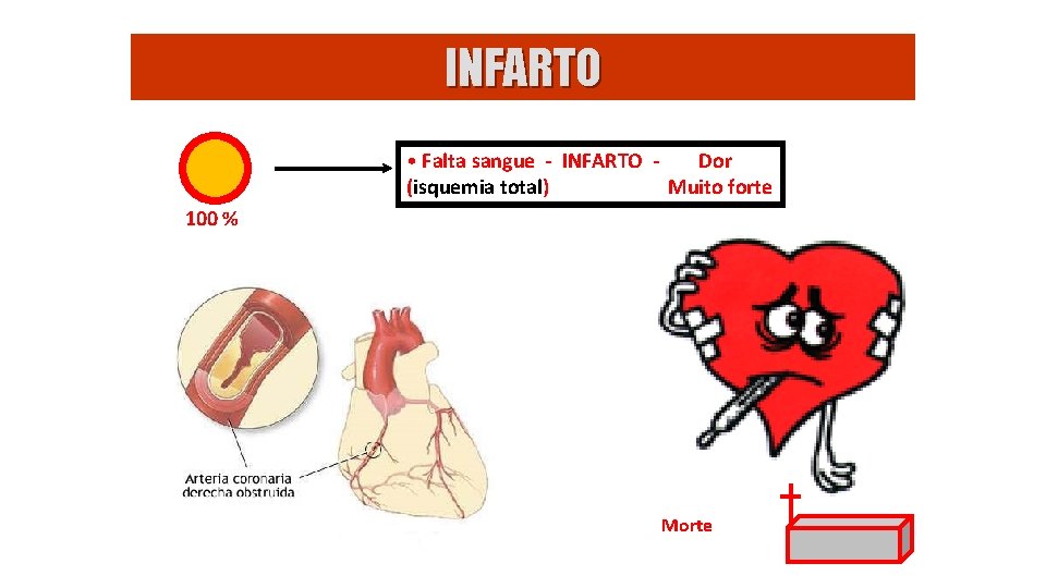 INFARTO • Falta sangue - INFARTO Dor (isquemia total) Muito forte 100 % Morte