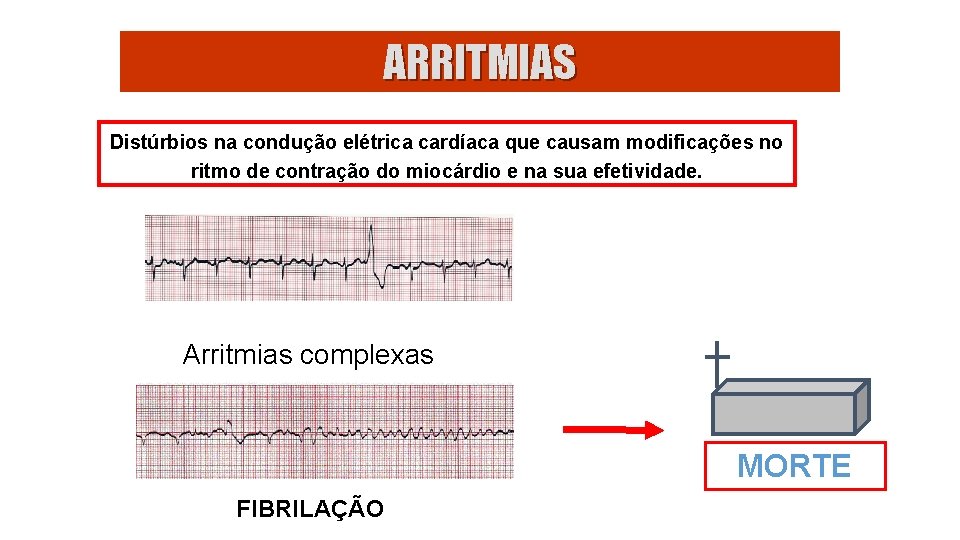 ARRITMIAS Distúrbios na condução elétrica cardíaca que causam modificações no ritmo de contração do