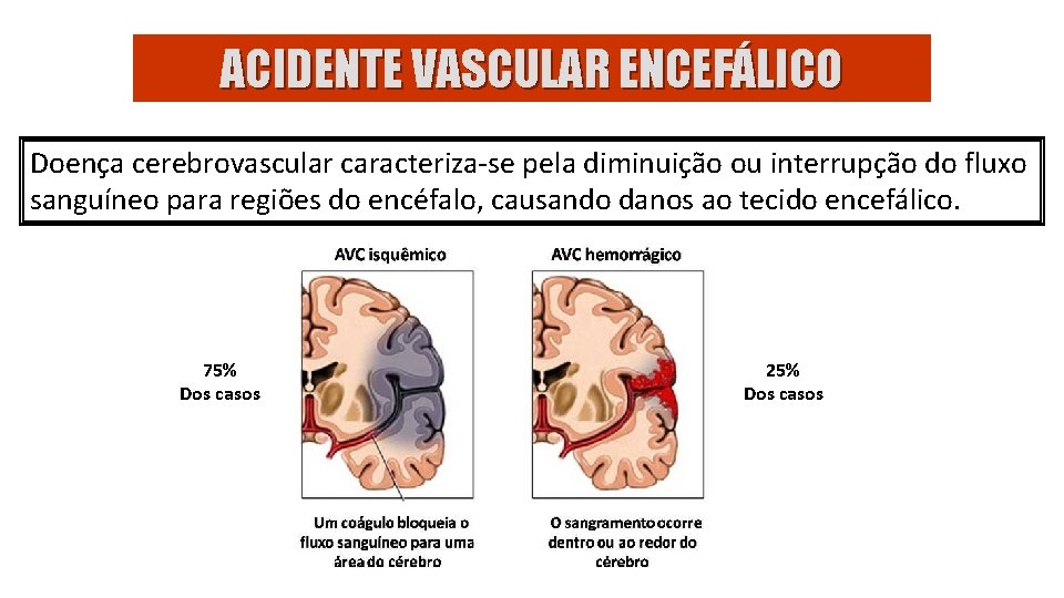 ACIDENTE VASCULAR ENCEFÁLICO Doença cerebrovascular caracteriza-se pela diminuição ou interrupção do fluxo sanguíneo para